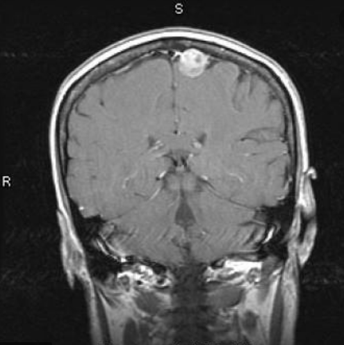 出國治療腦膜瘤哪個(gè)醫(yī)院好?德國INI腦膜瘤手術(shù)實(shí)例交流